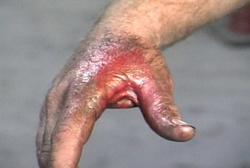 burned-hand