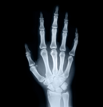 hand-x-ray