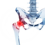 Should comp pay for hip replacement when there was pre-existing condition?